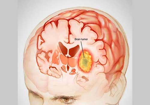 تومور مغزی ؛ علائم خاموش و نشانه های اولیه تومور مغزی ؛ علائم خاموش و نشانه های اولیه