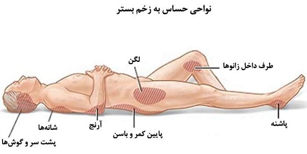 درمان زخم بستر