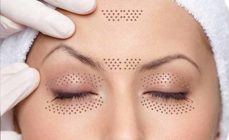 پلاسماجت چیست؟