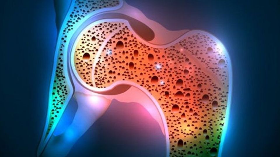 پوکی استخوان علائم عوامل خطر عوارض و پیشگیری