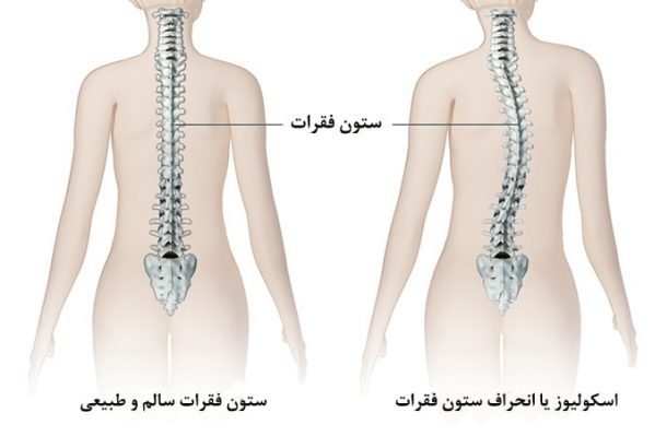 علت بروز انحراف ستون فقرات