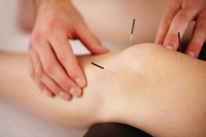 طب سوزنی چیست و برای درمان چه بیماری هایی استفاده می شود؟ طب سوزنی چیست و برای درمان چه بیماری هایی استفاده می شود؟