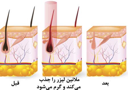 لیزر دایود لیزر موهای زائد با دستگاه دایود ؛ عوارض و هزینه